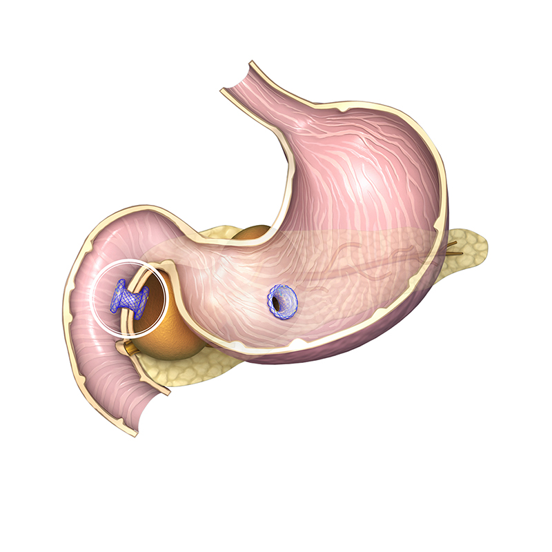 Kistogastrostomi Stent